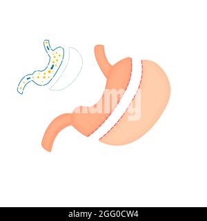 Chirurgie bariatrique de la membrane gastrique, illustration. Banque D'Images