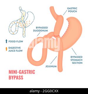 Mini chirurgie bariatrique de dérivation gastrique, illustration. Banque D'Images