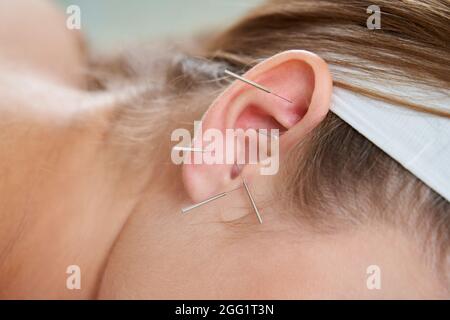 Belle femme se reposant sur un lit ayant un traitement d'acupuncture avec des aiguilles dans et autour de son oreille. Concept de thérapie alternative Banque D'Images