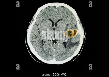 Une acquisition CT du cerveau d'un patient présentant de grands abcès cérébraux dans son lobe temporal gauche. Banque D'Images