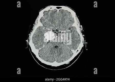 TDM cérébrale avec contraste d'un patient présentant une lésion rehaussant le bord de 3.8 cm au niveau du sinus caverneux droit avec calcification interne, le plus probable ménigiome Banque D'Images