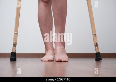 Une femme après une jambe cassée pour apprendre à marcher. Réhabilitation après retrait du pansement. Une femme marche sur des béquilles. Banque D'Images