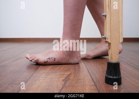 Une femme après une jambe cassée pour apprendre à marcher. Réhabilitation après retrait du pansement. Une femme marche sur des béquilles. Banque D'Images