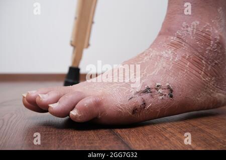 Une femme après une jambe cassée pour apprendre à marcher. Réhabilitation après retrait du pansement. Suture postopératoire sur le pied, la jambe après la fracture et Banque D'Images