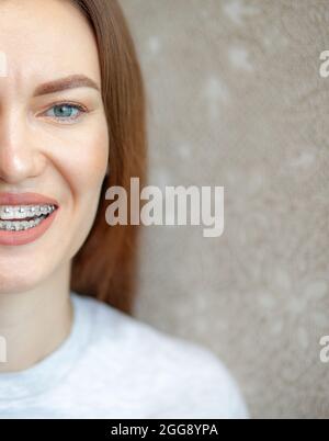 Le sourire d'une jeune et belle fille avec des bretelles sur ses dents blanches. Redressement des dents tortravers à l'aide d'un système de support. Malocclusion Banque D'Images