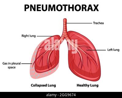 Schéma pneumothorax avec poumon collabé et poumon sain Illustration de Vecteur