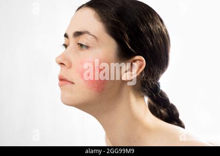 Coupé. Portrait d'une jeune belle femme caucasienne avec rosacée sur sa joue. Isolé sur un fond blanc. Le concept de la cosmétologie. Banque D'Images