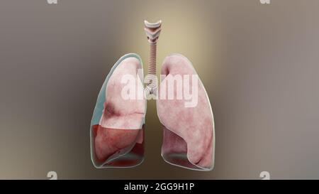 illustration 3d de l'hémopneumothorax, poumon normal versus collapsus, symptômes de l'hémopneumothorax, épanchement pleural, empyema, complications Banque D'Images