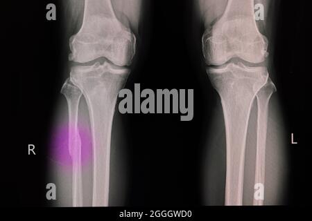 Film radiographique d'un genou d'un patient présentant un péroné proximal fracturé. Fracture osseuse de la jambe. Banque D'Images