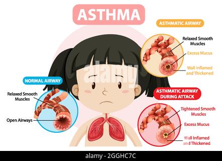 Schéma de l'asthme avec illustration des voies aériennes normales et des voies respiratoires asthmatiques Illustration de Vecteur