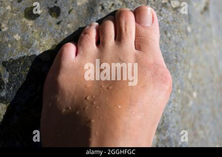 Bions ou Hallux valgus, pied de femme d'âge moyen Banque D'Images