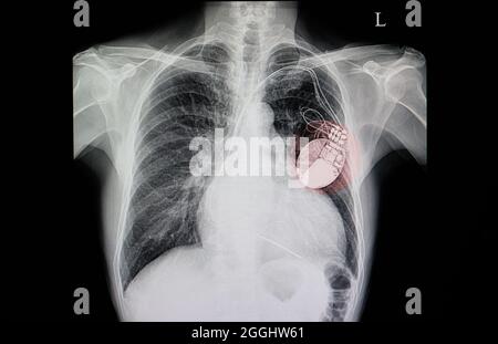 Film radiographique thoracique d'un patient porteur d'un stimulateur cardiaque, également avec un cœur congestif et une cardiomégalie Banque D'Images