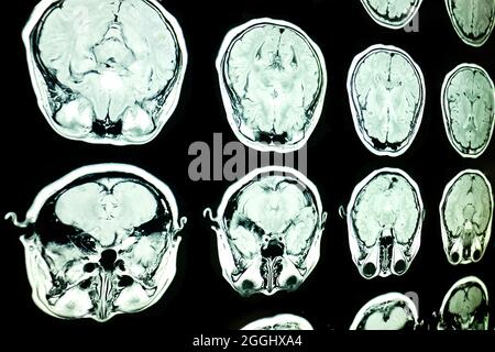 Images par résonance magnétique ou IRM du cerveau. Banque D'Images