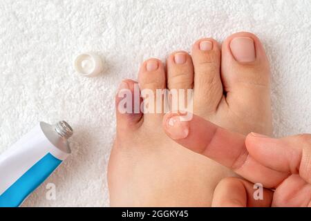Gel pour les ecchymoses sur l'index au-dessus de l'orteil meurtri du pied de la femme. Blessure du pied petit doigt après un accident à la maison. Pointe pinky cassée. Ci-dessus. Banque D'Images