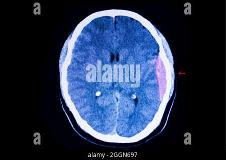 Scanner du cerveau d'un patient en accident de la circulation montrant une importante hémorragie épidurale sur son hémisphère cérébral gauche avec un certain degré d'œdème cérébral Banque D'Images