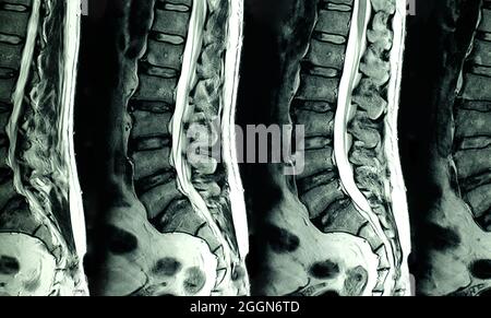 Examen IRM des épines lombaires d'un patient souffrant de douleurs dorsales chroniques montrant un changement dégénératif des épines lombaires, une hernie discale lombaire et une composition de la racine nerveuse Banque D'Images