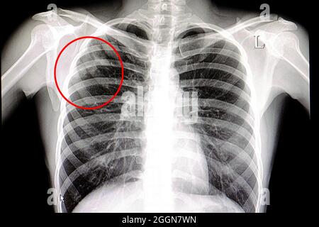 La tuberculose. X-ray de la poitrine d'un patient atteint de ...