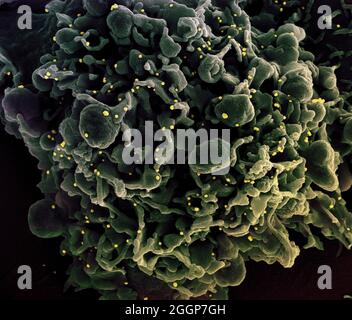 Micrographe électronique à balayage colorisé d'une cellule infectée par des particules du virus du COV-SRAS (jaune), isolée d'un échantillon de patient. Banque D'Images