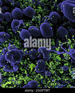 Micrographe électronique à balayage colorisé d'une cellule apoptotique (violet) fortement infectée par des particules du virus du COV-SRAS (vert), isolée d'un échantillon de patient. Banque D'Images