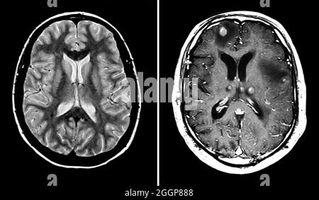 Sur la gauche se trouve une image IRM axiale normale du cerveau à travers les deux hémisphères cérébraux.À ce niveau, vous voyez deux grandes cavités remplies de matériau foncé.Ce sont les ventricules latéraux qui sont remplis de liquide céphalo-rachidien (LCR).Il existe deux principaux types de tissu cérébral, la matière grise (qui contient les corps cellulaires neuronaux et est la plus foncée du tissu cérébral illustré) et la matière blanche (qui est composée de fibres axonales).Sur la droite se trouve une IRM axiale d'un cerveau montrant plusieurs tumeurs malignes.Ces nodules tumoraux sont entourés d'un gonflement important. Banque D'Images