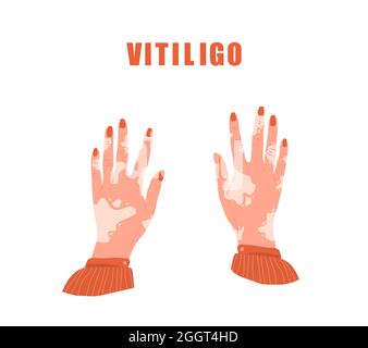 Mains femelles avec vitiligo. Journée mondiale du vitiligo. Maladie de la peau. Soin de soi et amour de soi. Illustration vectorielle de style dessin animé plat Illustration de Vecteur