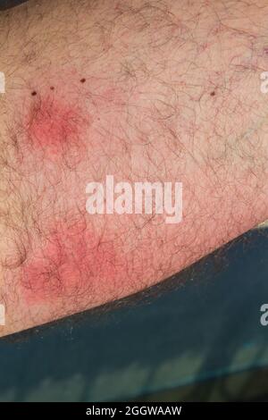 Piqûres de guêpes sur la peau après deux jours, des marques d'inflammation rouges causées par des morsures de guêpes Banque D'Images