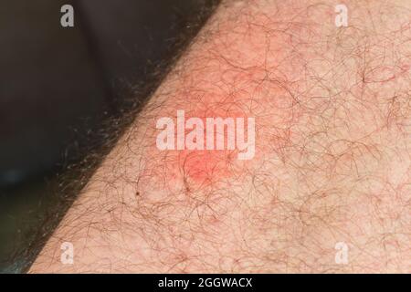 Piqûres de guêpes sur la peau après une journée, des marques d'inflammation rouges causées par des morsures de guêpes Banque D'Images