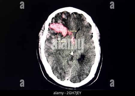 Scanner le cerveau d'un patient thrombocytopénique avec un gros caillot de sang dans la zone frontale droite à partir d'une hémorragie intracérébral. Banque D'Images