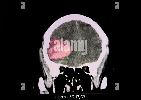 Scanner le cerveau d'un patient thrombocytopénique avec un gros caillot de sang dans la zone frontale droite à partir d'une hémorragie intracérébral. Banque D'Images