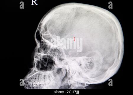Film radiographique du crâne d'un patient traumatisant présentant une fracture linéaire temporopariétale du crâne. Banque D'Images