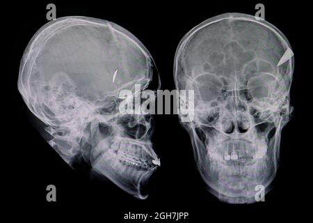 Films radiographiques d'un patient avec une pointe de couteau retenue dans le crâne. Lésion pénétrante du crâne. Banque D'Images