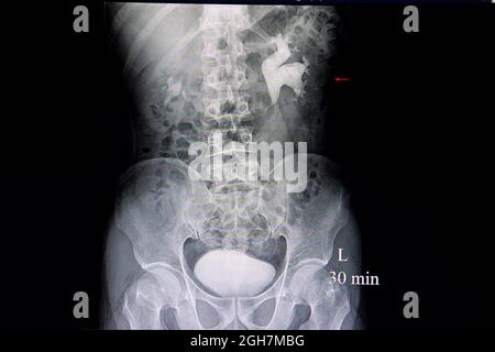 Film de rayons X par pyelogramme intraveineux d'un patient souffrant d'hydronéphrose et de multiples calculs rénaux. Banque D'Images