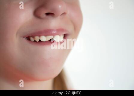 Deux dents femelles avant sont cassées. La fille est tombée et a frappé ses dents. Banque D'Images