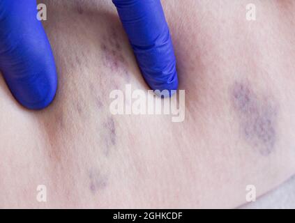 Le médecin examine la jambe d'un patient qui a des varices et une thrombose veineuse. Traitement varices Banque D'Images