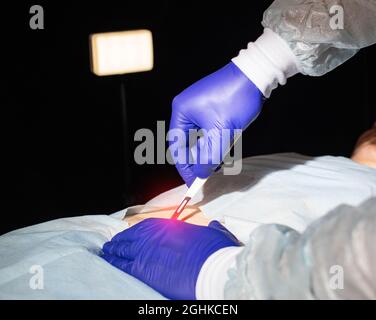 Médecin chirurgien avec un scalpel dans la main avant la chirurgie intestinale dans un patient, gros plan. Concept d'enlèvement de la partie de l'intestin grêle et traiteurs de la maladie intestinale Banque D'Images