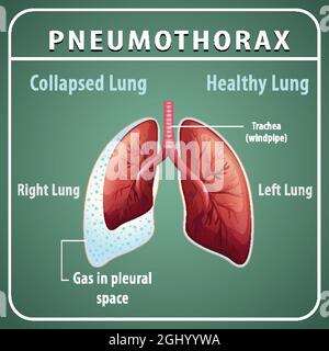Schéma pneumothorax avec poumon collabé et poumon sain Illustration de Vecteur