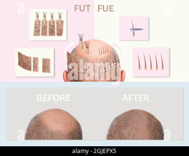 Méthodes de transplantation de cheveux FUT et FUE Fue avec la transplantation comme élément d'illustration. Alopécie humaine ou problème de perte de cheveux sur l'homme adulte âgé ou mature. Avant et après le concept Banque D'Images