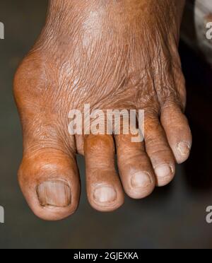 Inflammation des articulations des pieds. Concept de douleur articulaire du pied, arthrite rhumatoïde, hyperuricema ou goutte. Banque D'Images