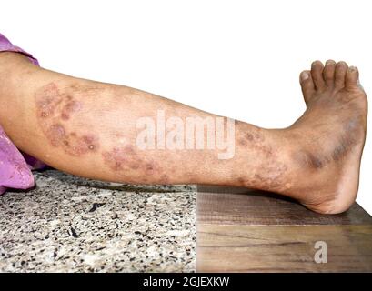 Infection fongique appelée tinea corporis dans la jambe de la femme asiatique. Ver annelé répandu sur le membre inférieur. Banque D'Images