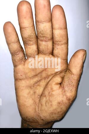 Infestation de gale géante ou gale norvégienne en main de l'Asie du Sud-est, homme birman. Maladie contagieuse de la peau causée par les acariens. Banque D'Images