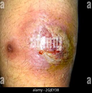 Infection cutanée à streptocoque ou staphylococcal de grande taille dans le haut du dos du patient birman asiatique. Banque D'Images