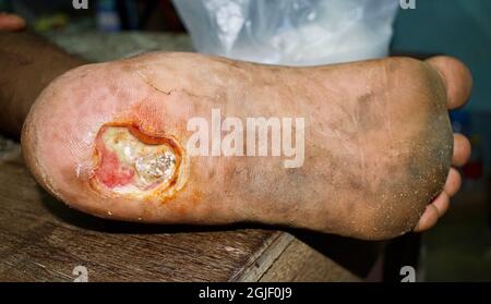 Diabète ulcère du pied dans le pied de patient asiatique. Vue en gros plan. Banque D'Images