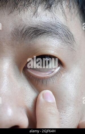 Peau pâle de l'homme asiatique. Signe d'anémie. Pâleur à la paupière. Vue en gros plan. Banque D'Images