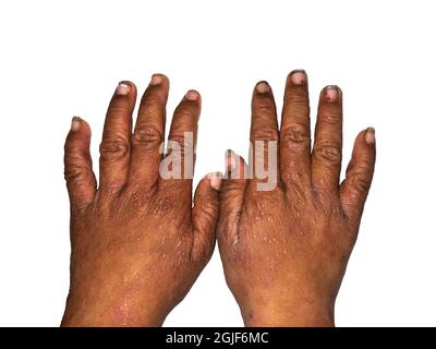 Infestation de la gale entre les mains de l'Asie du Sud-est, enfant birman. Mains rugueuses et sales. Isolé sur blanc. Banque D'Images