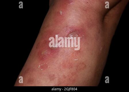 Infection cutanée staphylococcique, streptococcique ou impétigo bulleux et cellulite à la jambe du patient asiatique. Isolé sur le noir. Banque D'Images