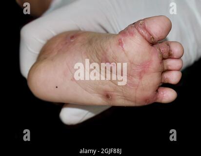 Infestation de gale avec infection bactérienne secondaire ou superposée et pustules au pied de l'Asie du Sud-est, enfant birman. Une maladie contagieuse de la peau Banque D'Images