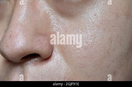 Peau huileuse avec de larges pores face à l'asiatique du Sud-est, Myanmar ou coréen adulte jeune homme. Vue en gros plan. Banque D'Images