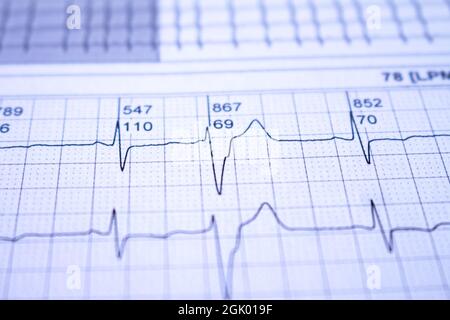 Battements de cœur représentés sur le papier millimétré. Électrocardiogramme avec foyer sélectif. Arythmies cardiaques. Banque D'Images