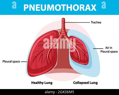 Schéma pneumothorax avec poumon collabé et poumon sain Illustration de Vecteur