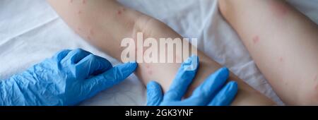 Médecin avec des gants examine les jambes avec des taches rouges de petite fille. Banque D'Images